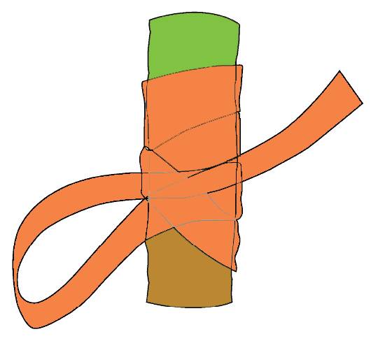 Illustration showing how a slip knot is tied onto a graft.